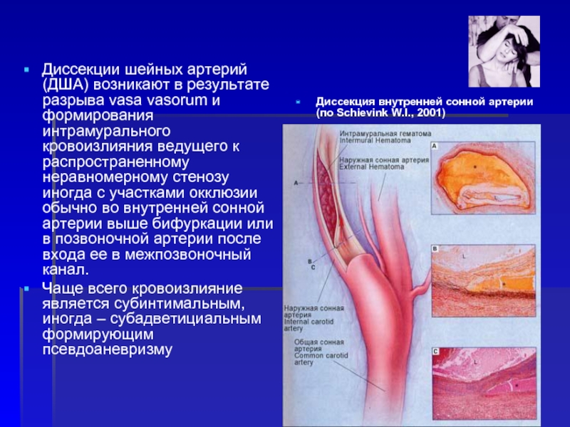 Диссекции шейных артерий (ДША) возникают в результате разрыва vasa vasorum и