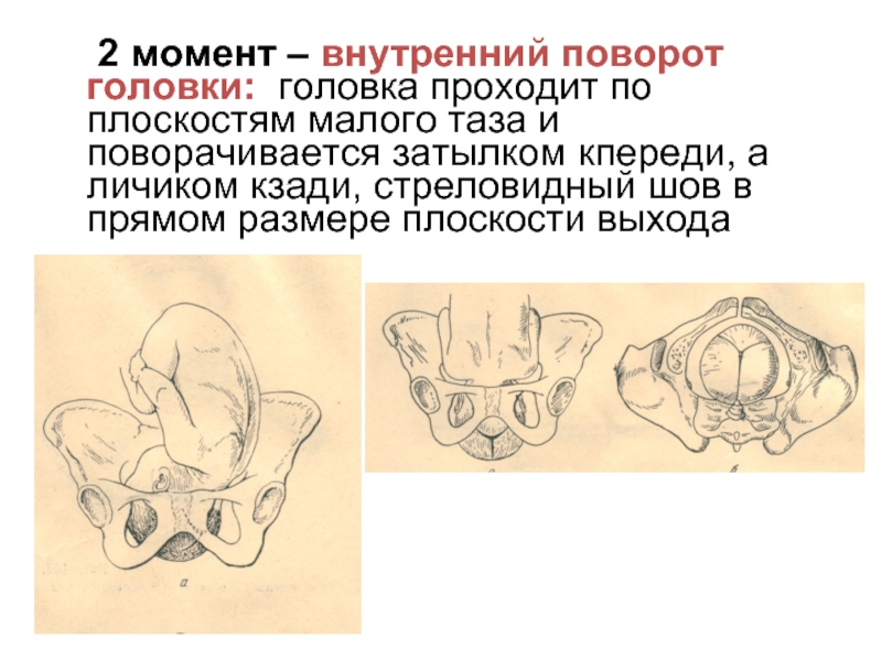 Внутренней занимавшему. Стреловидный шов и малый Родничок. Головка плода в плоскостях малого таза. Стреловидный шов в прямом размере выхода таза. Головка плода в плоскости выхода.