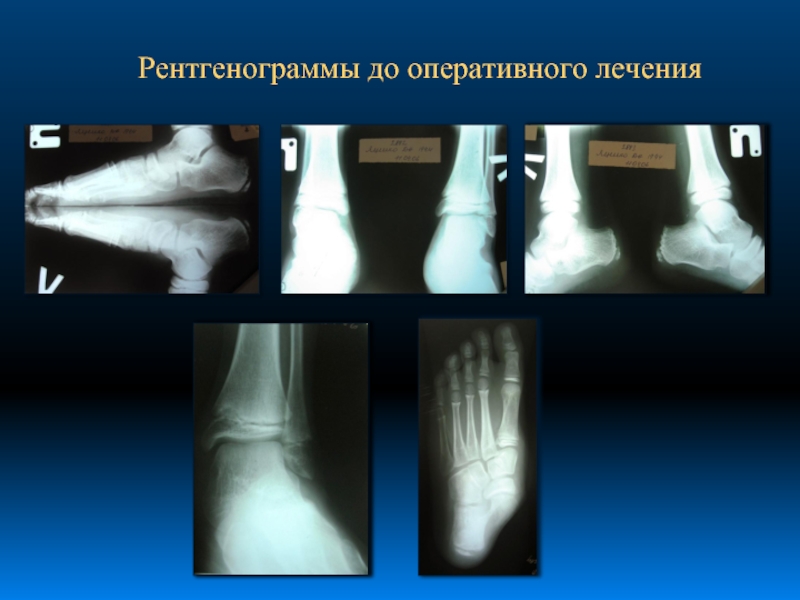 Вальгусная деформация стопы рентген фото