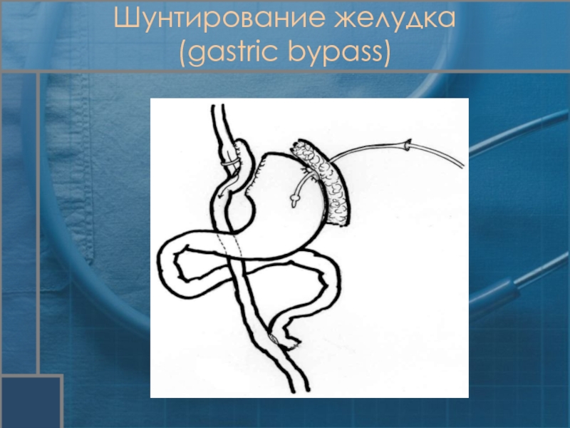 Шунтирование желудка. Шунтирование желудка шов. Шунтирование желудка на короткой петле.