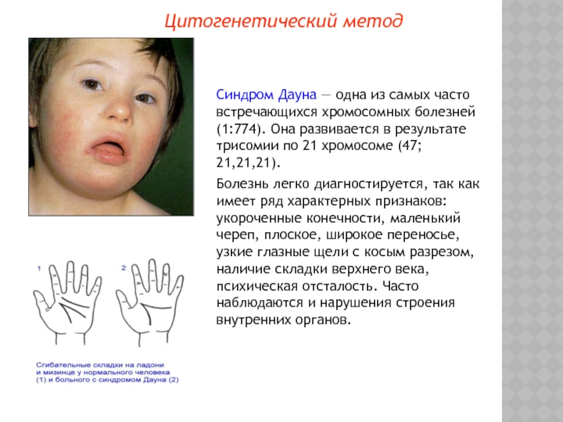 Болезнь дауна какой. Синдром Дауна (трисомия по 21 паре хромосом). Синдром Дауна (трисомия по 21-Ой хромосоме);. Дети с синдромом Дауна трисомия. Синдром Дауна Тип наследования.