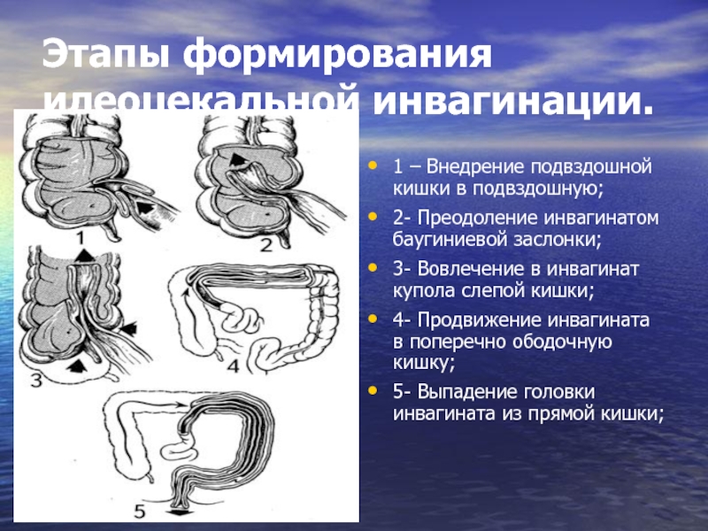 Колоноскопия до купола слепой кишки что это значит