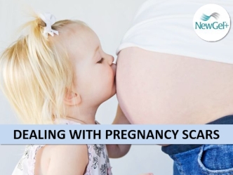 DEALING WITH PREGNANCY SCARS