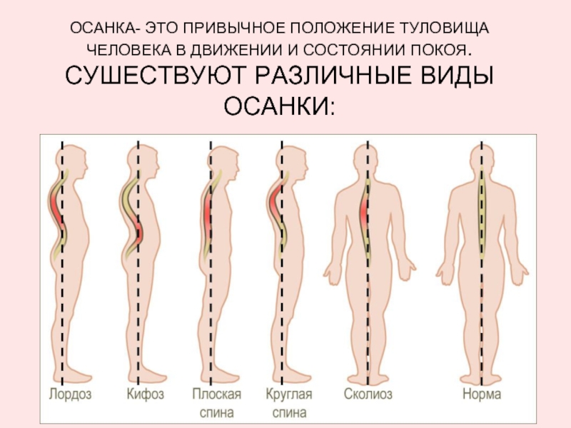 Как называют нарушение осанки изображенное на рисунке 3