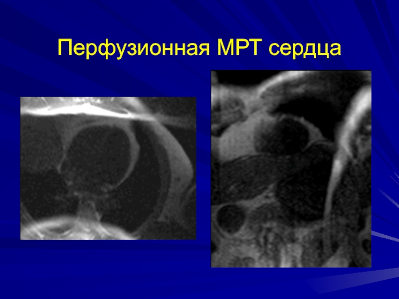 Перфузионная МРТ сердца