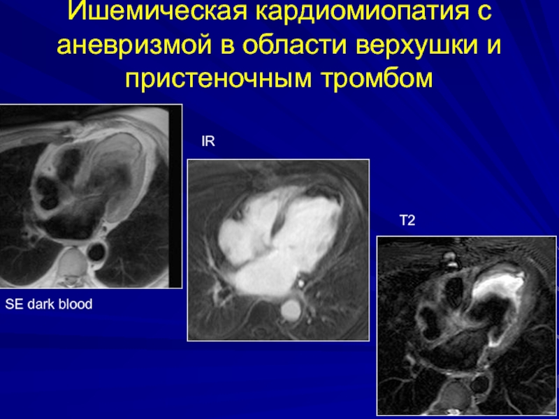 Ишемическая кардиомиопатия с аневризмой в области верхушки и пристеночным тромбомSE dark bloodIRT2