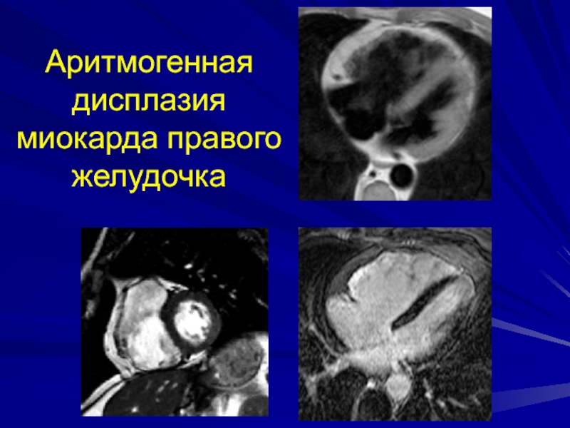 Аритмогенная дисплазия миокарда правого желудочка