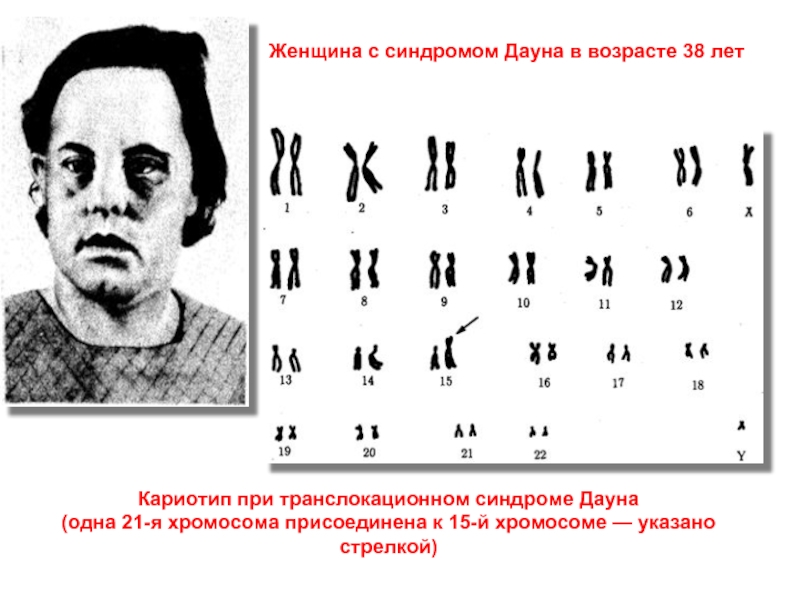 Кариотип при транслокационном синдроме Дауна(одна 21-я хромосома присоединена к 15-й хромосоме