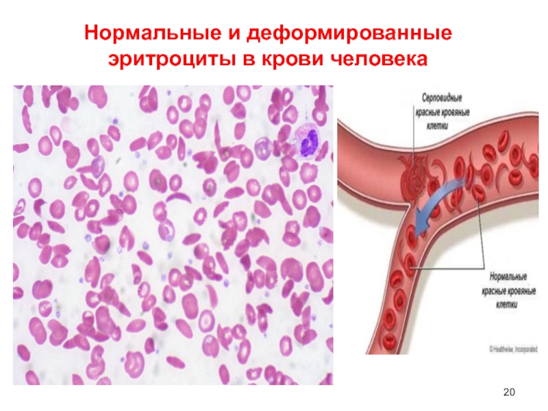 Нормальные и деформированные эритроциты в крови человека