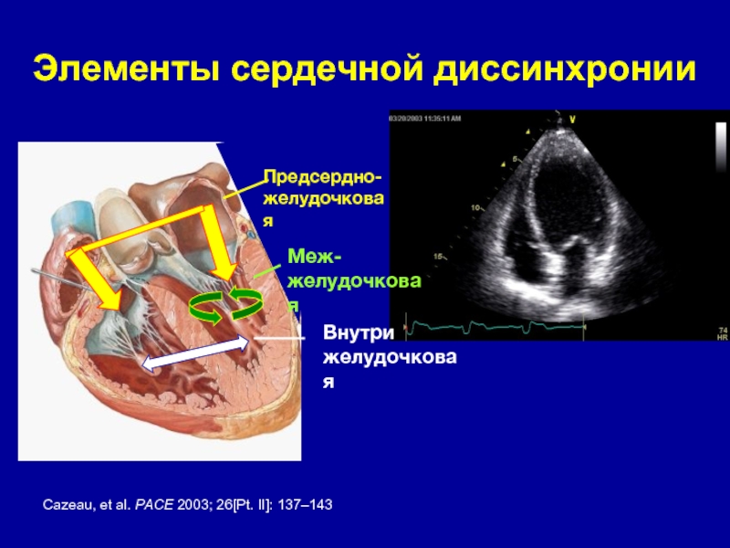 Элементы сердечной диссинхронииПредсердно-желудочковаяCazeau, et al. PACE 2003; 26[Pt. II]: 137–143 Меж-желудочковаяВнутрижелудочковая