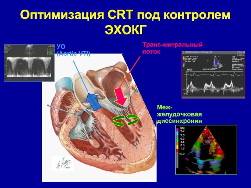 Оптимизация CRT под контролем ЭХОКГТранс-митральныйпотокУО(Aortic VTI)Меж-желудочковаядиссинхрония
