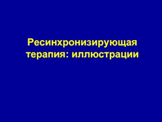 Ресинхронизирующая терапия: иллюстрации