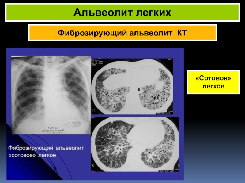 Альвеолиты у детей презентация