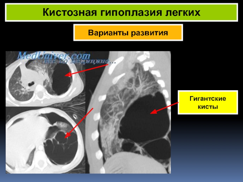 Гипоплазия легкого презентация