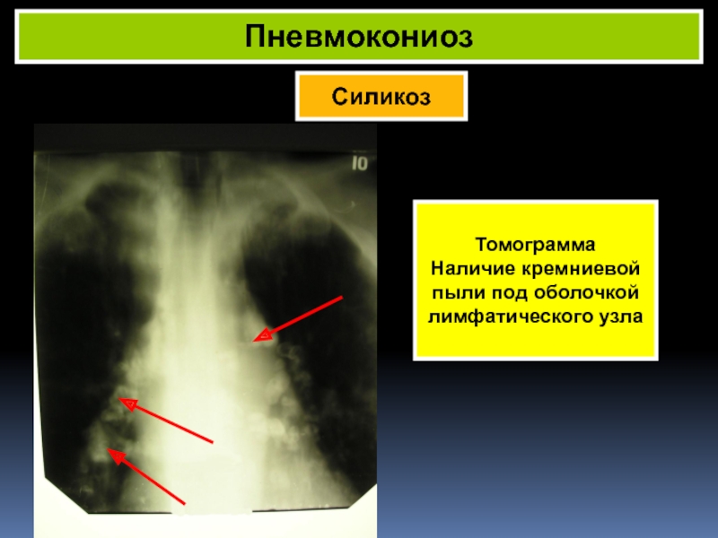 Диагностика силикоза. Варианты течения силикоза. Силикоз кт. Пневмокониозы и силикозы презентация мушаред.