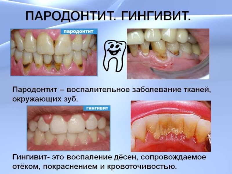 Скачать Реферат На Тему Пародонтоз История Возникновения