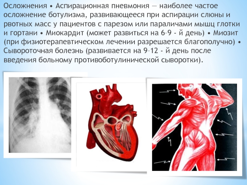 Наиболее частым осложнением. Последствия аспирационной пневмонии. Наиболее частое осложнение пневмонии. Аспирационные осложнения.