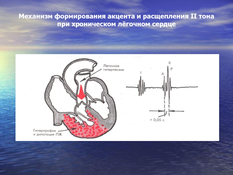 Хроническое легочное сердце презентация