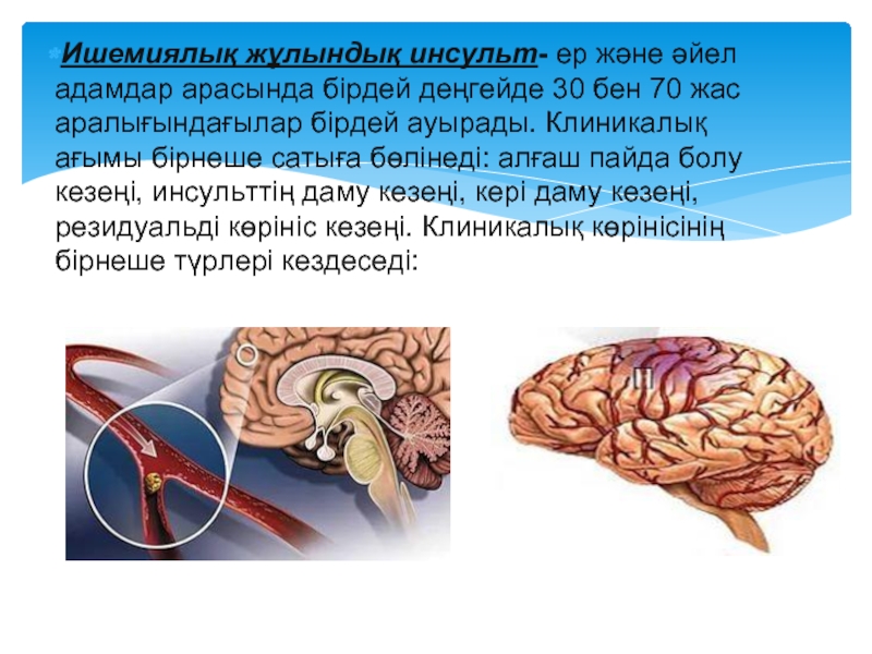 Ишемиялық инсульт презентация