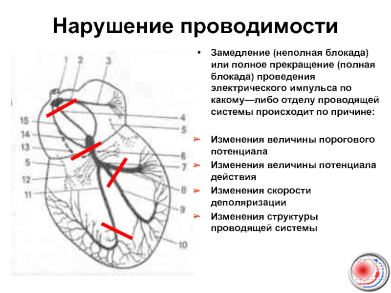 Замедление проводимости. Блокада проводящей системы сердца. Нарушение функции проводящей системы сердца. Проводящая система сердца блокады ЭКГ. Нарушение проводимости блокады сердца.