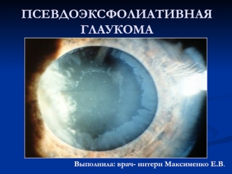 Псевдоэксфолиативная глаукома