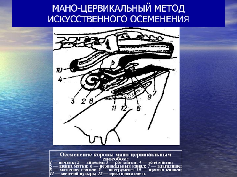 Подготовка стола для ректоцервикального метода осеменения