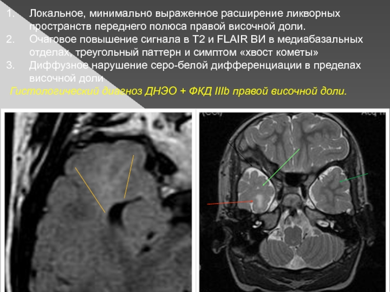 Мультинодулярная вакуолизирующая нейрональная опухоль мрт картинки