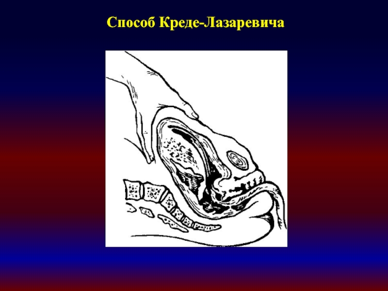 Способ род. Абуладзе Гентера Креде-Лазаревичу. Отделение последа Креде-Лазаревичу. Способ Креде Лазаревича. Способ отделения последа по Креде-Лазаревичу.