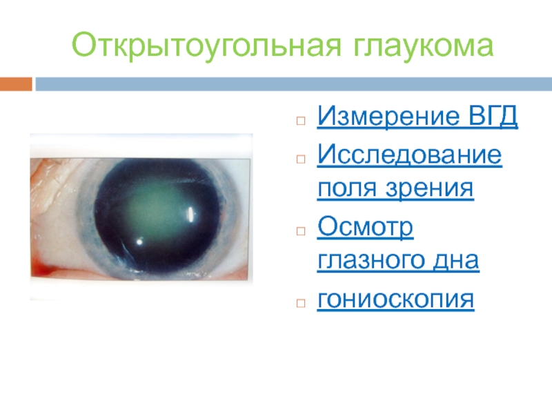 Глаукома глаз презентация, доклад