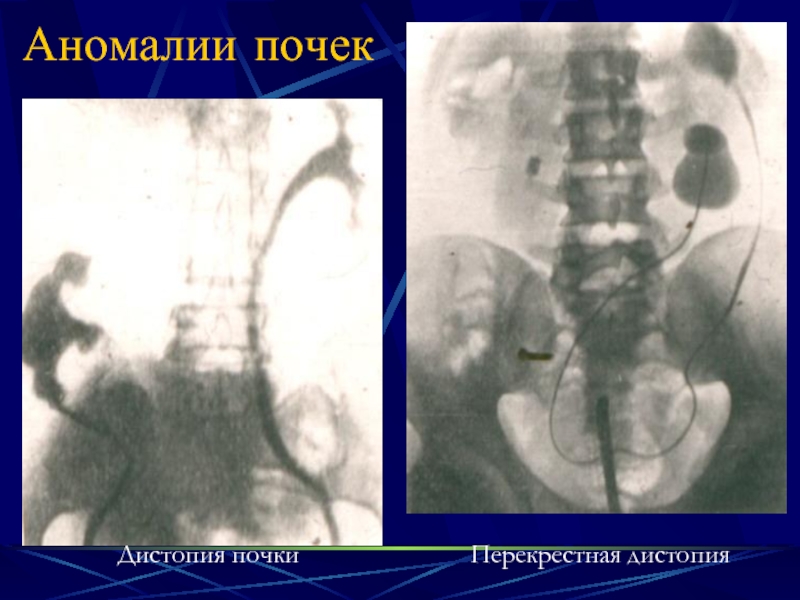 Аномалии развития почки картинки