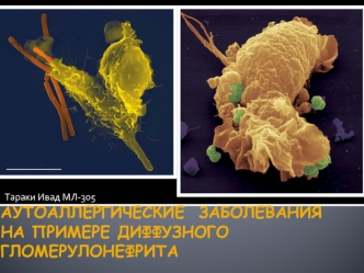 Аутоаллергические заболевания на примере диффузного гломерулонефрита