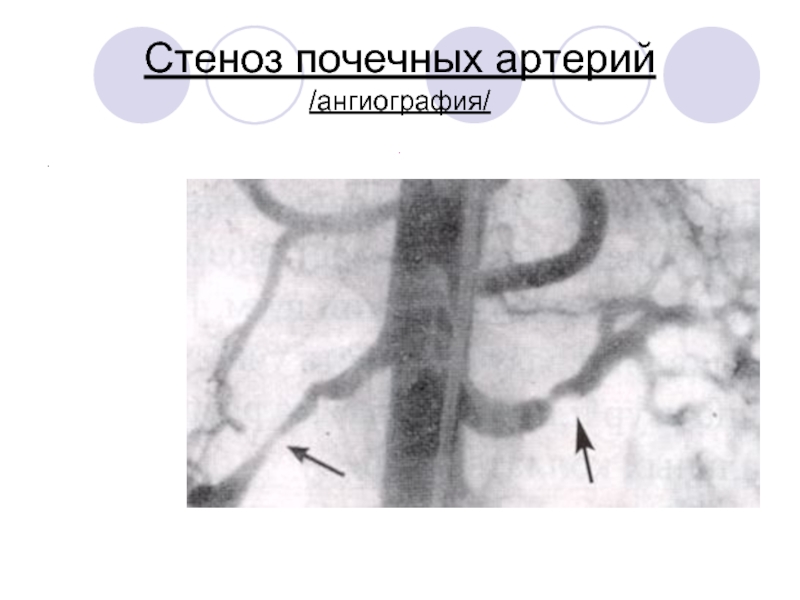 Почечная артерия. Фибромускулярный стеноз почечной артерии. Стеноз почечной артерии. Стеноз почечной артерии ангиография. Атеросклеротический стеноз почечной артерии.