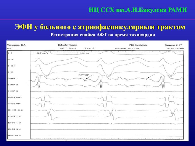 Синдром предвозбуждения желудочков CLC синдром. Эфи глаз протокол. Синдром предвозбуждения желудочков презент. Атриофасцикулярный тракт.