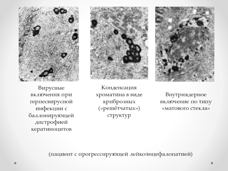 Дегенерация клеток. Внутриядерные включения. Цитомегаловирус внутриядерные включения. Типы вирусных включений.