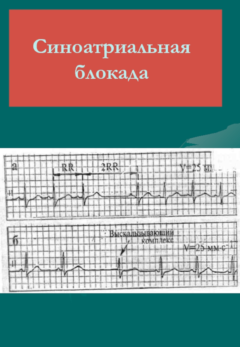 Признаки синоатриальной блокады. Синоатриальная блокада 3 степени на ЭКГ. ЭКГ критерии синоатриальной блокады. Са блокада Мобитц 1.