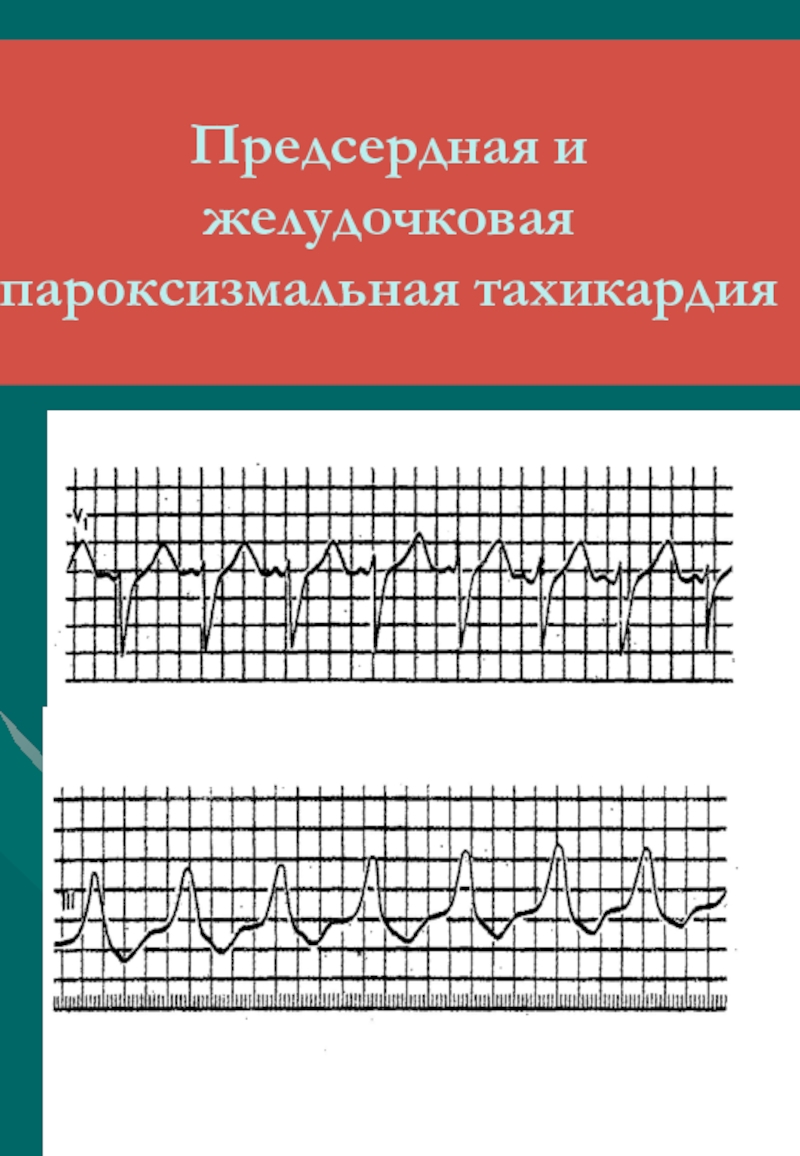 Пароксизмальная тахикардия. Пароксизмальная тахикардия ЭКГ. Предсердная пароксизмальная тахикардия на ЭКГ. Синусовая реципрокная тахикардия ЭКГ. Предсердная и желудочковая тахикардия.