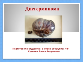 Дисгерминома. Классификация
