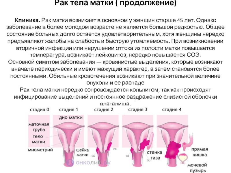 Тело матки. Опухоли тела матки стадии.