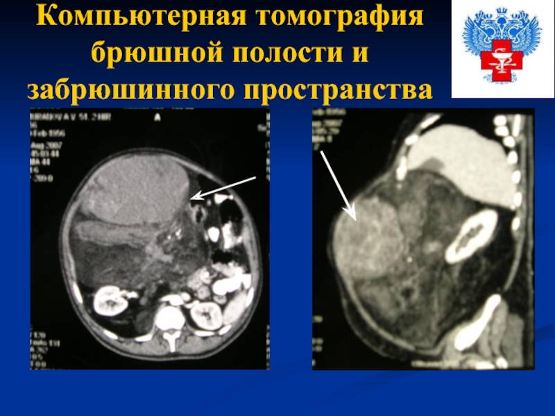 Что показывает кт брюшной. Кт томография брюшной полости. Кт брюшной полости и забрюшинного пространства. Кт органов брюшной полости и забрюшинного пространства. Пространства брюшной полости на кт.