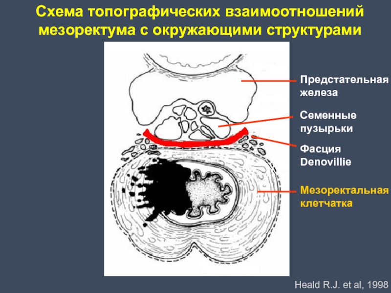 Рак нижнеампулярного отдела прямой кишки