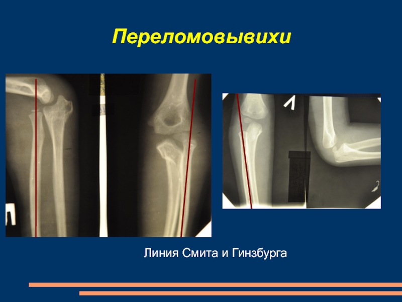 Нарушение линии. Линия Смита при переломе. Линия Смита в травматологии. Линия Смита и ГИНЗБУРГА.