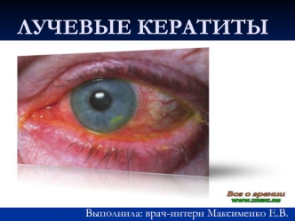 Лучевые кератиты