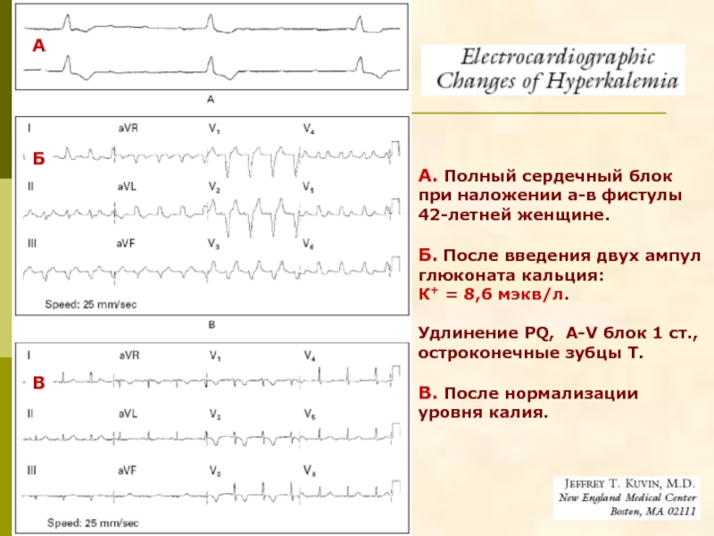 Гиперкалиемия на экг картинки