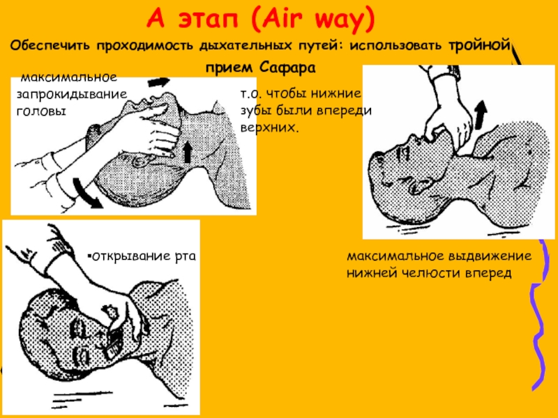 Проходимость дыхательных путей тройной прием Сафара. Прием запрокидывание головы выдвижение нижней челюсти обеспечивает. Нарушение проходимости верхних дыхательных путей тест