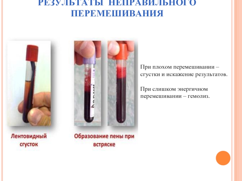 Иммунофиксация сыворотки крови