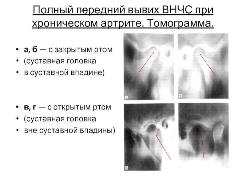 Артрит внчс фото