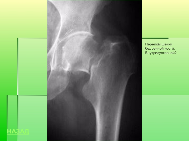 Перелом бедра. Оскольчатый перелом шейки бедра рентген. Внесуставные переломы шейки бедра. Базальный перелом бедра рентген. Внутрисуставной перелом шейки бедра.