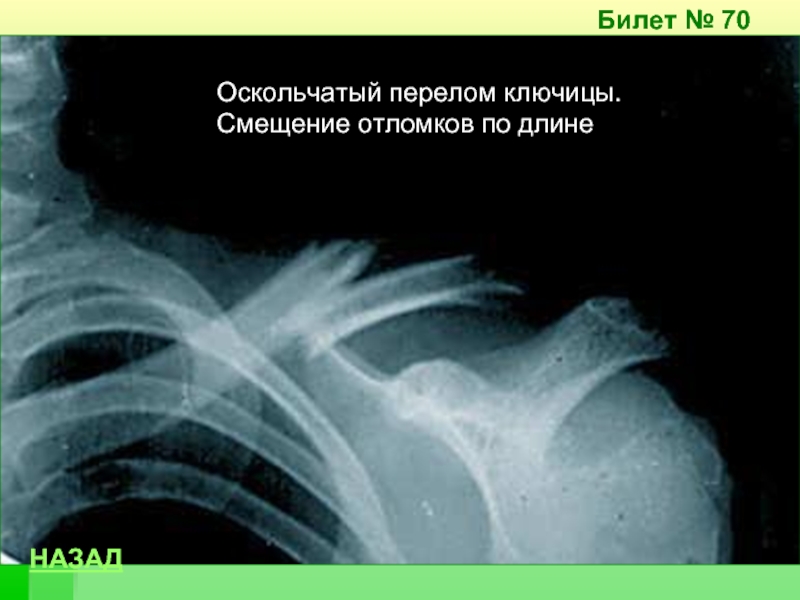 Сколько заживает перелом ключицы после операции. Перелом средней трети ключицы со смещением отломков. Осколочный перелом ключицы со смещением. Смещение отломков ключицы. Перелом ключицы со смещением снимок.