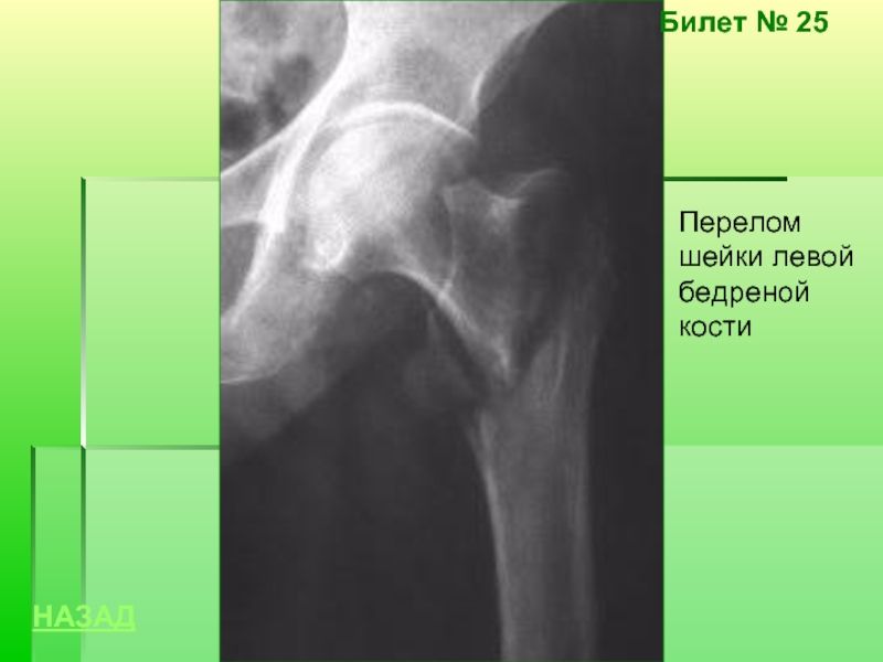 Трещина шейки. Субкапитальный перелом шейки левой бедренной кости. Вколоченный перелом шейки бедренной кости рентген. Субкапитальный перелом шейки бедра рентген. Вколоченный перелом шейки бедра рентген.