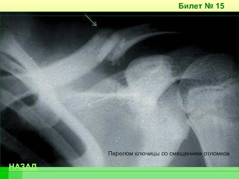 Перелом ключицы со смещением. Оскольчатый перелом ключицы рентген. Поднадкостничный перелом ключицы. Многооскольчатый перелом ключицы. Периимплантный перелом ключицы.